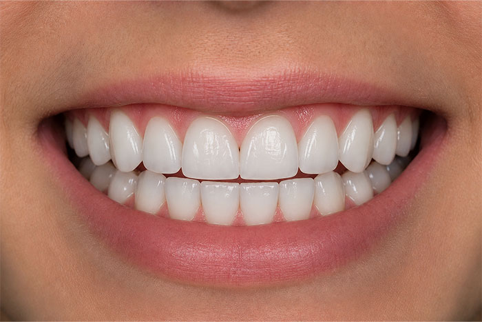 Cosmetic-Composite-Bonding-Path-after Cosmetic-Composite-Bonding-Path-after