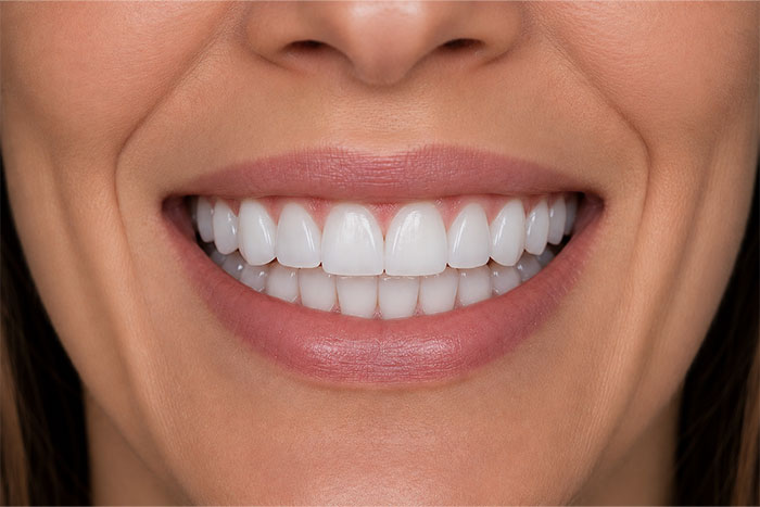 Porcelain-Veneers-Placement-Case-after Porcelain-Veneers-Placement-Case-after