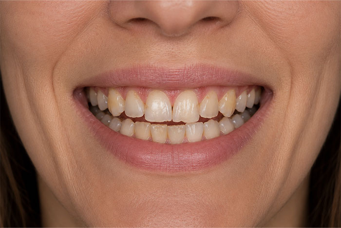 Porcelain-Veneers-Placement-Case-before Porcelain-Veneers-Placement-Case-before