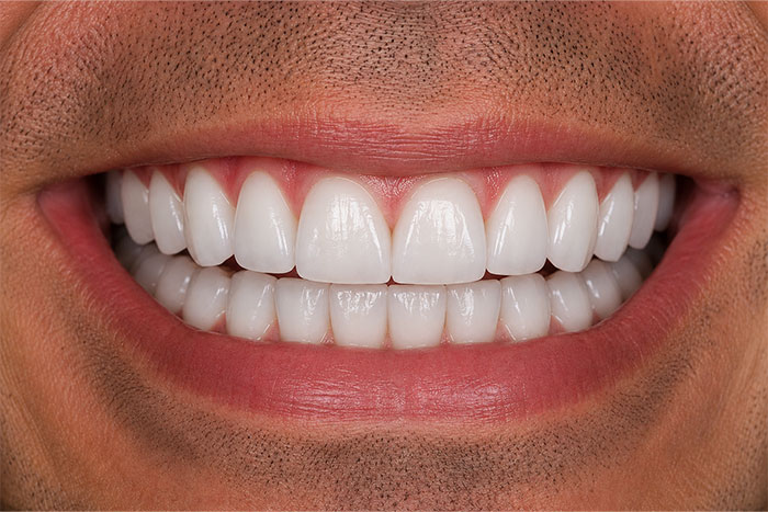 Smile-Makeover-after Smile-Makeover-after
