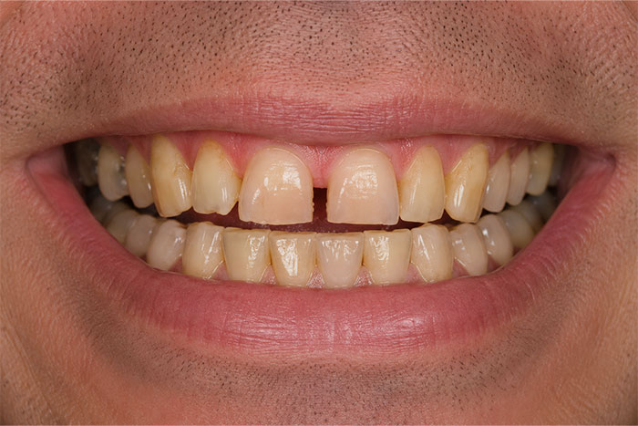 Smile-Makeover-before Smile-Makeover-before