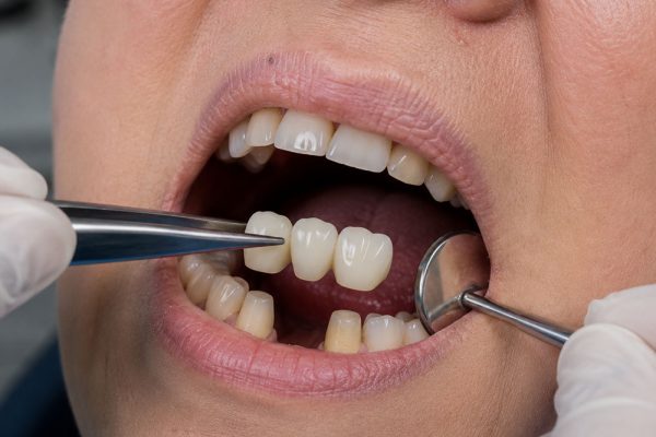 Dental-bridges