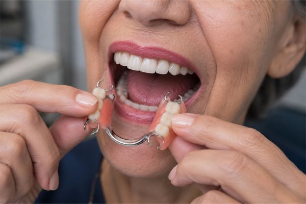 Dentures-&-partials